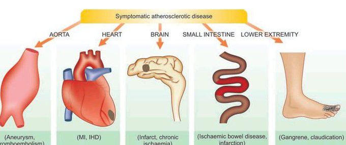 Symptomatic atherosclerotic disease.