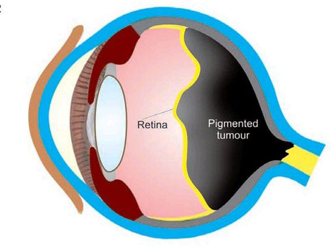 Choroidal melanoma