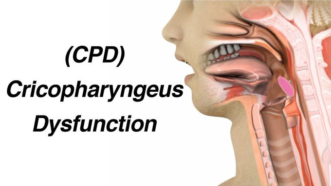 Cricopharyngeus Dysfunction (CPD)