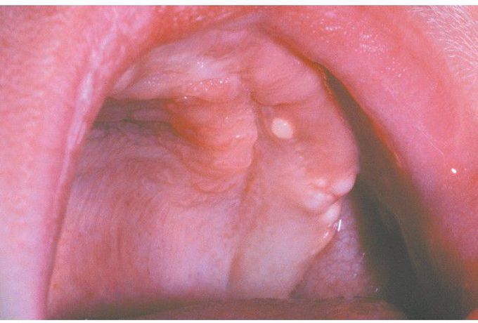 Gingival Cyst of the Newborn.