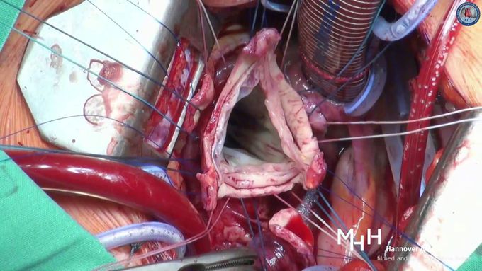 David procedure through an upper partial sternotomy