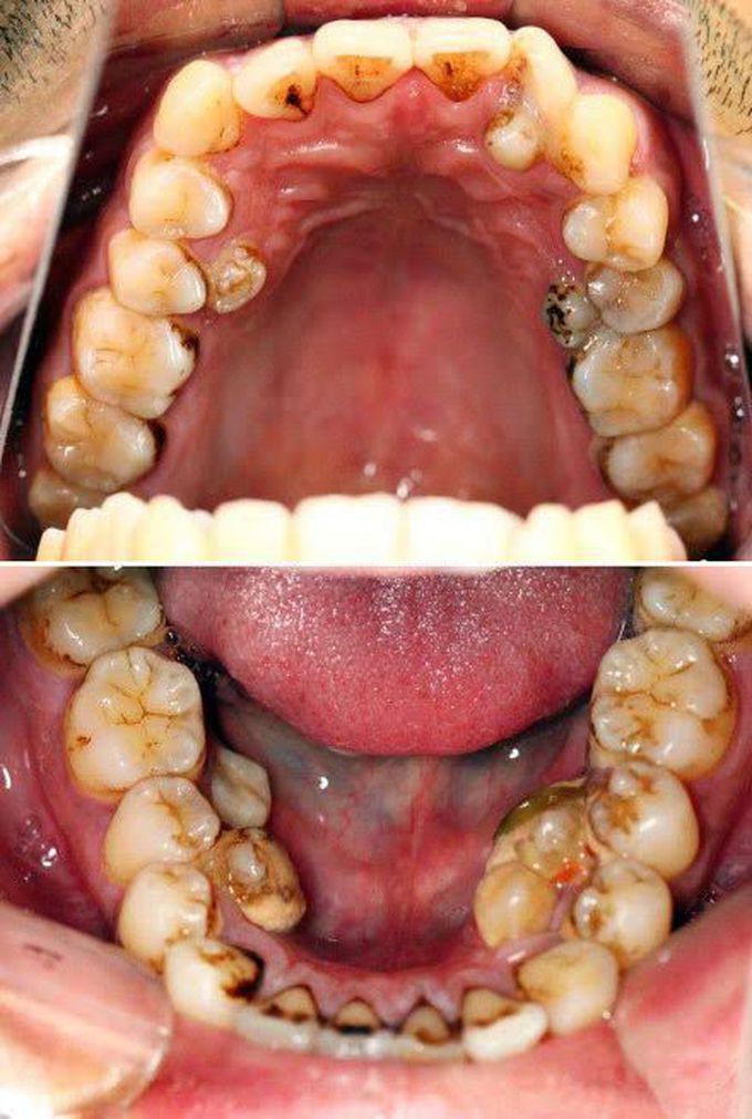 Hyperdontia