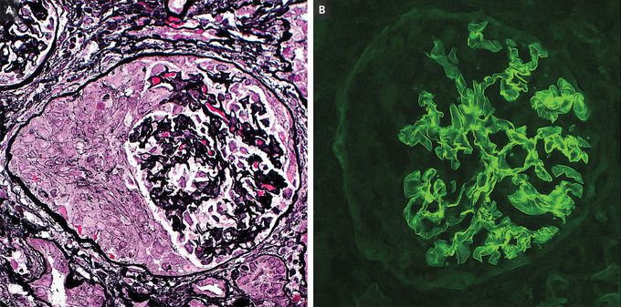 Anti–Glomerular Basement Membrane Glomerulonephritis