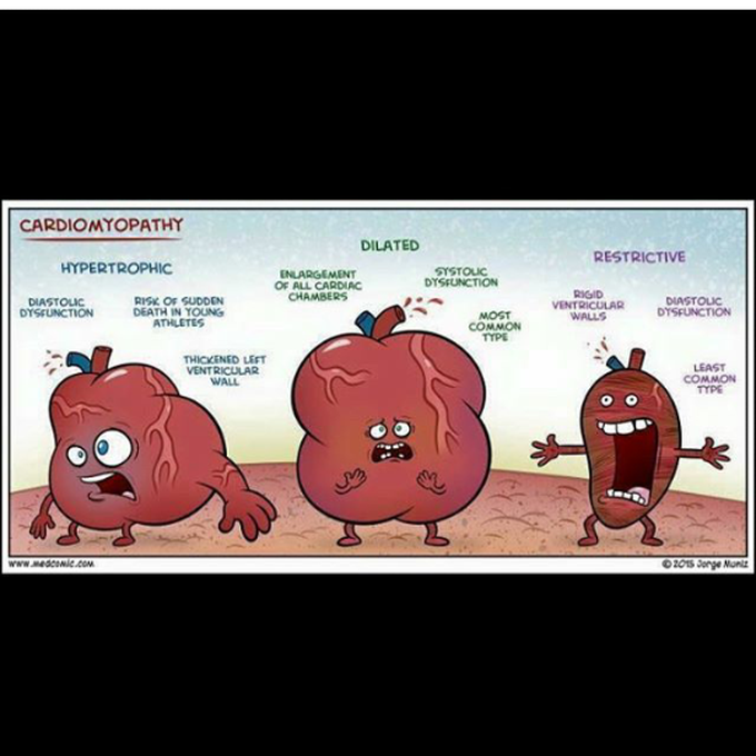 Cardiomyopathy