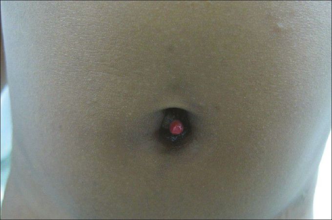 Raspberry tumour