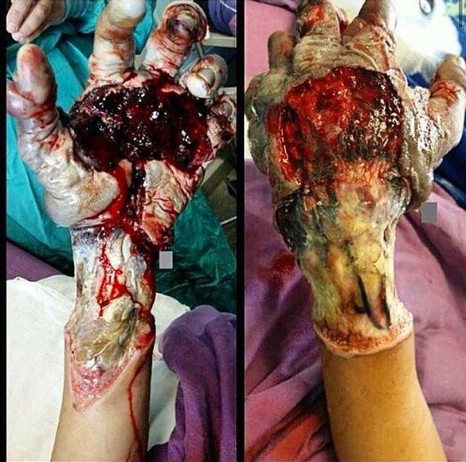 Severe hand burn