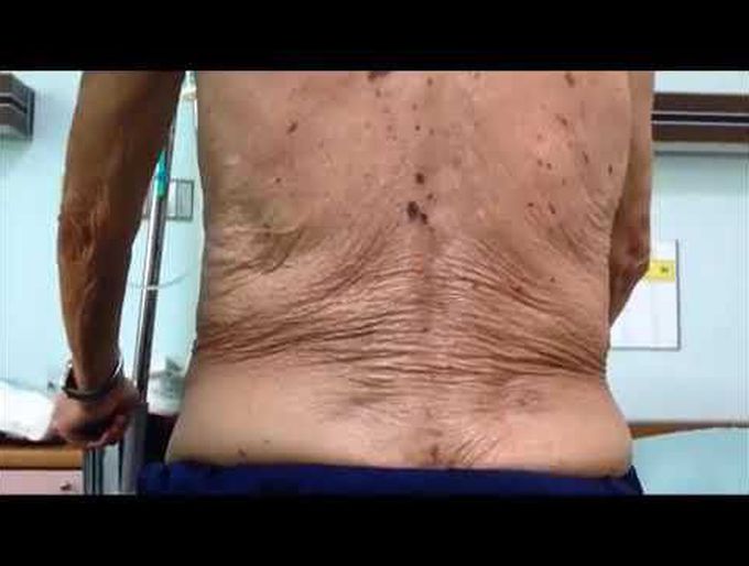 Disappearing Hernia and Grynfeltt Hernia