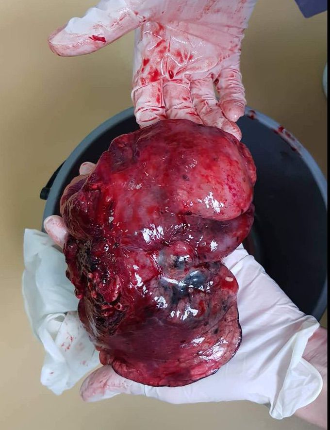 Lobectomia due to carcinoma pulnonum