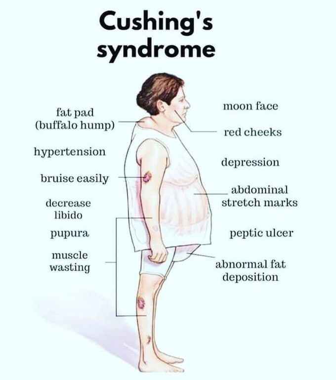 Cushing's Syndrome