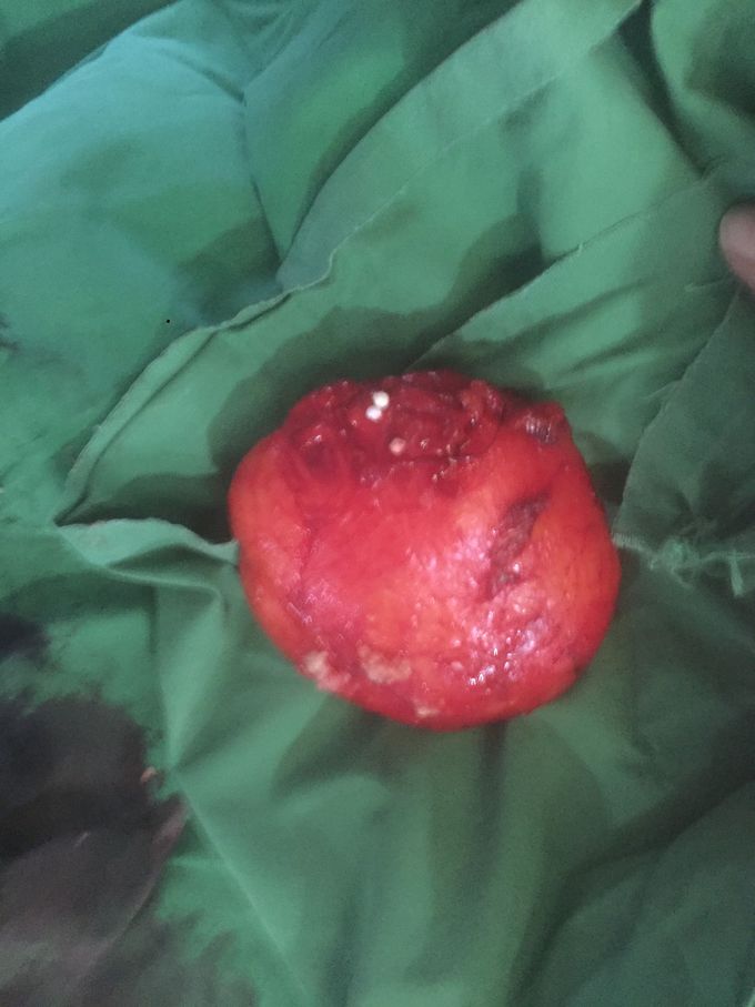 Lipoma