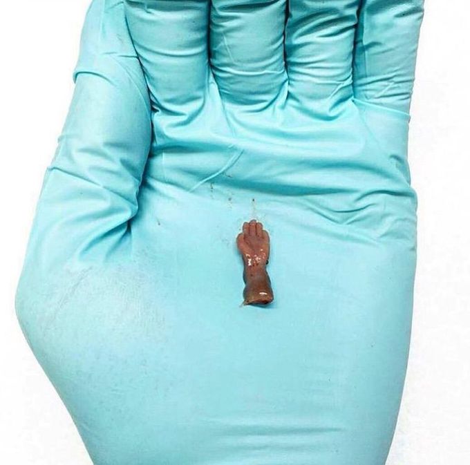 Smallest fetal hand in an adult hand!