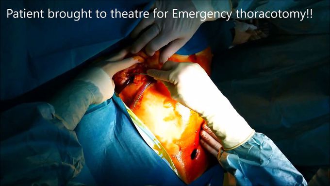 Emergency Thoracotomy for actively bleeding traumatic lung laceration - Wedge Lung resection