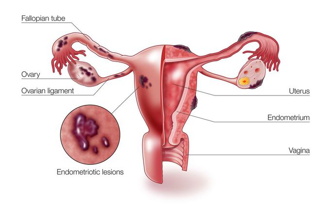 Endometriosis - MEDizzy
