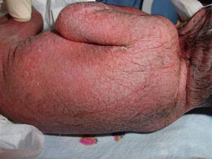 Septicemia