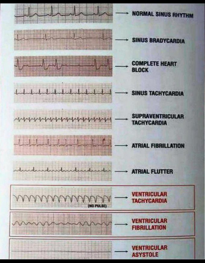 ECG Graph