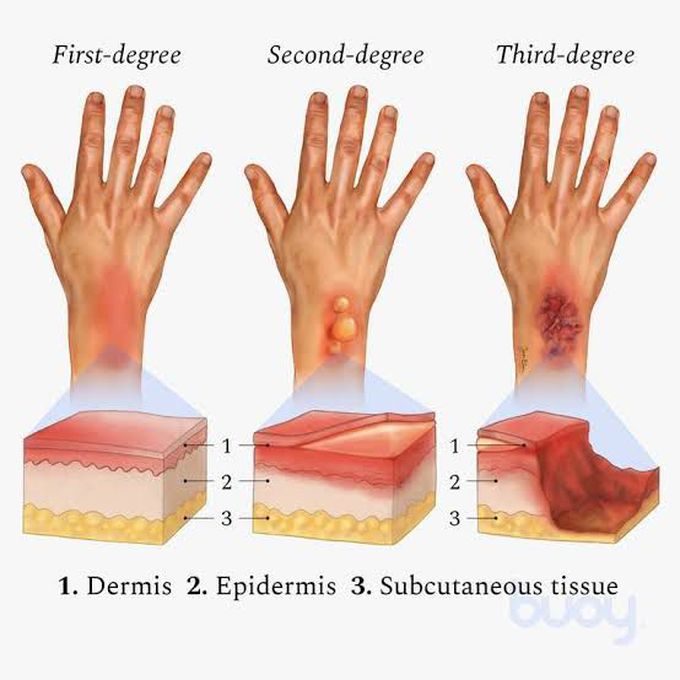Degrees of burn and their symptoms