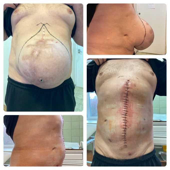 Before/after photo of patient with a big postoperative hernia. Separation plastic is made.