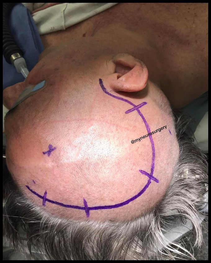 Trauma flap