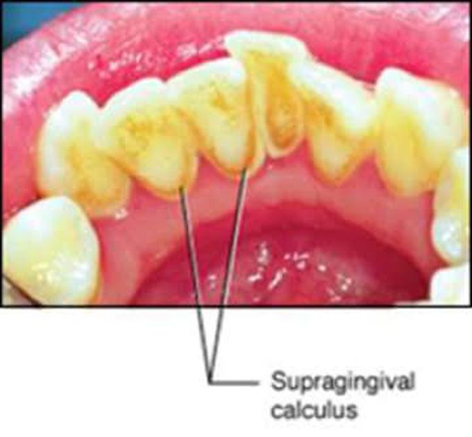 Supraginigval calculus