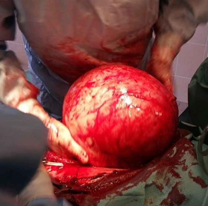 Very Big Cyst of The Right Kidney 🤕