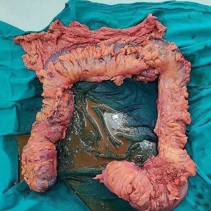 Total Colectomy
