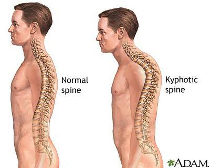 Treatment of kyphosis