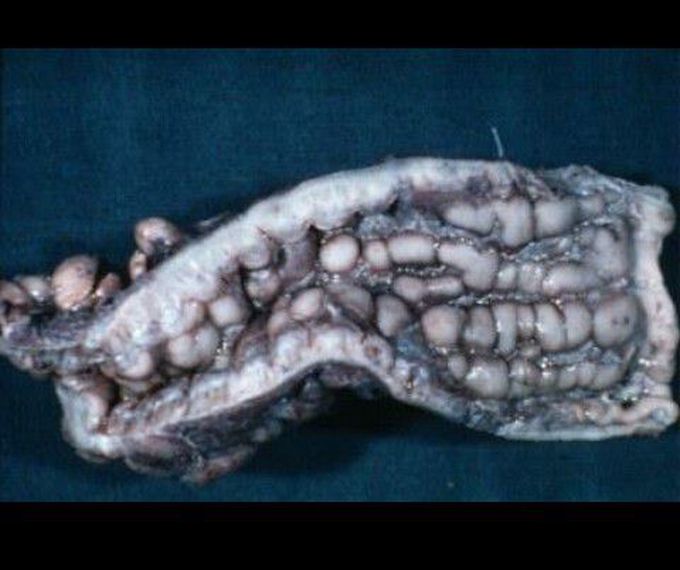 Crohns Disease