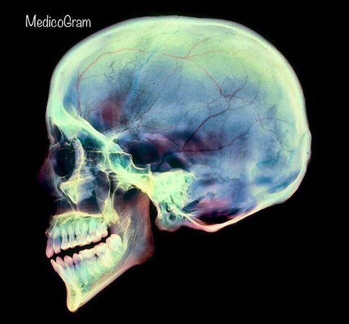 Coloured X-ray of a sagittal section through a human skull