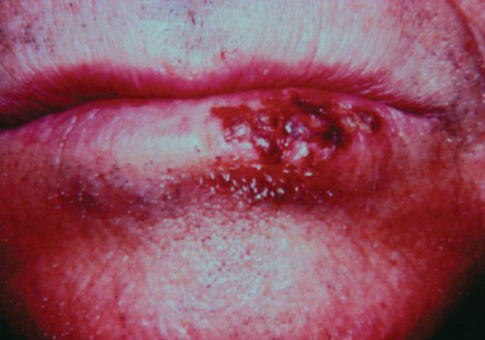 Herpes labialis