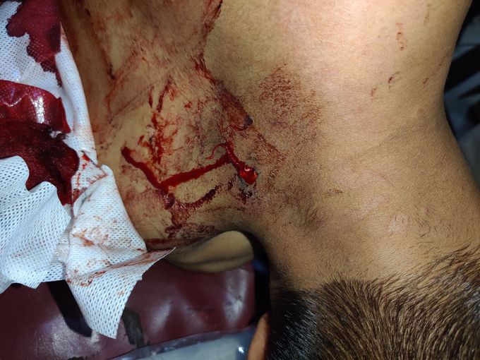 Gunshot pallet on nape of neck