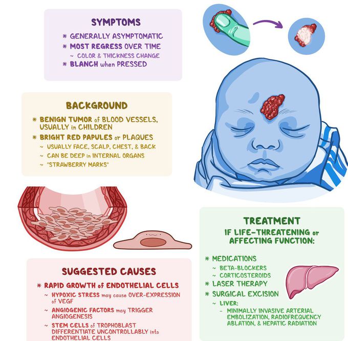 Treatment for Hemangioma