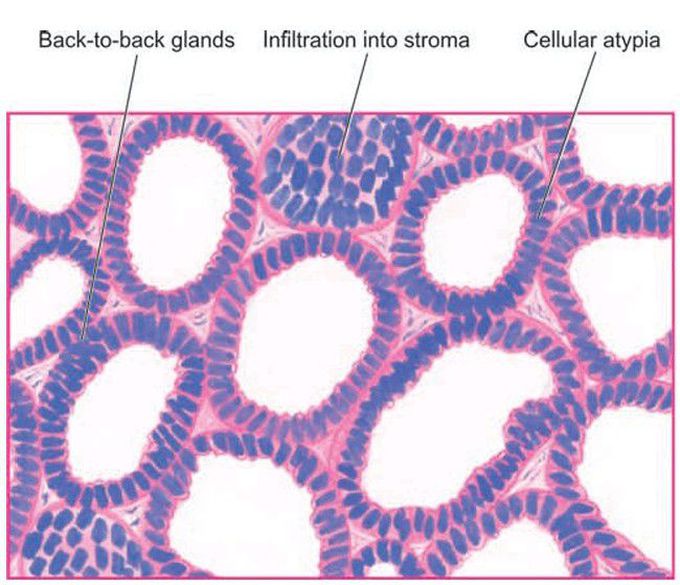 Endometrial carcinoma.