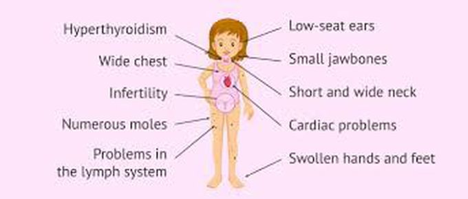 Symptoms If Turners Syndrome Medizzy