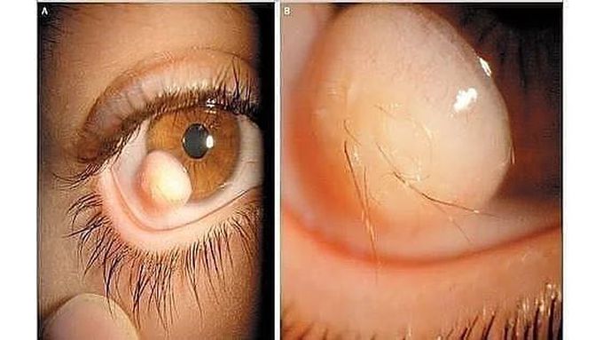 Limbal Dermoid