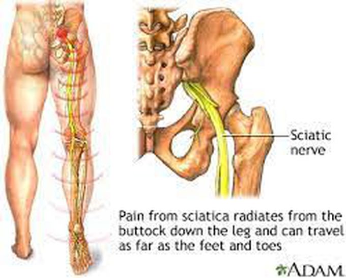 How is sciatica treated