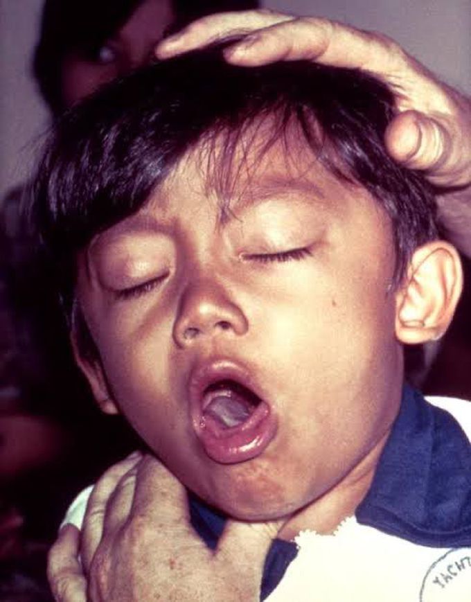 Whooping Cough