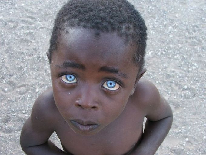 ocular-albinism-medizzy