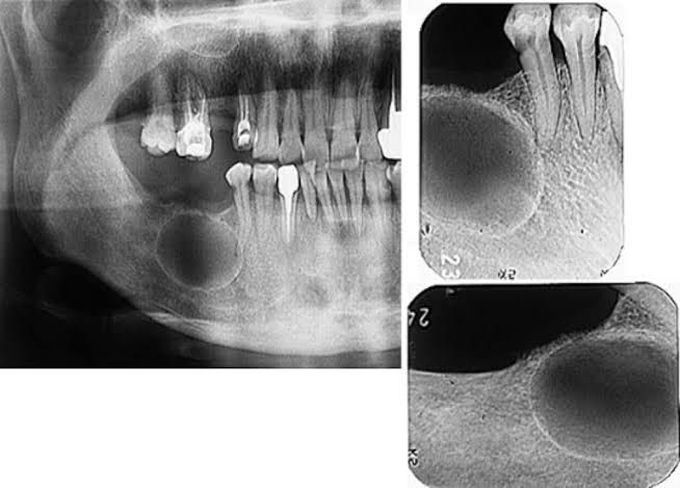 Odontogenic keratocysts