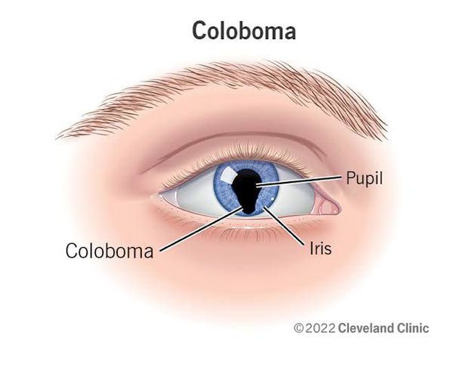 Coloboma