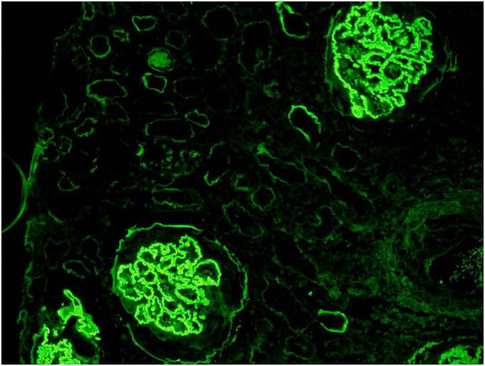Goodpasture Syndrome