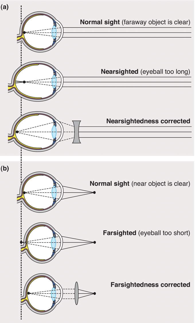 common optical defects in eye