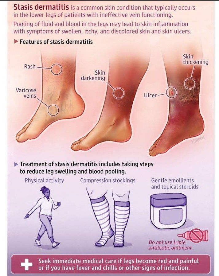 Statis dermatitis - MEDizzy