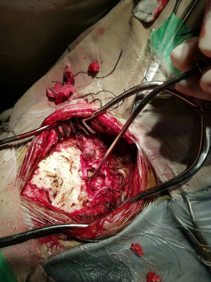 Neurosurgery