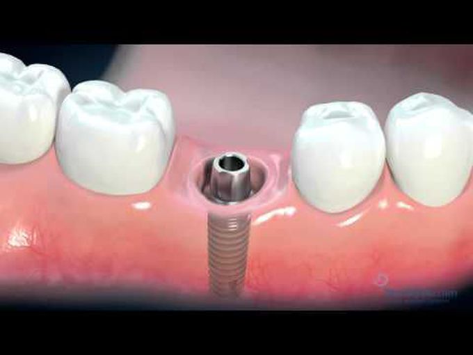Dental Implant-Animation