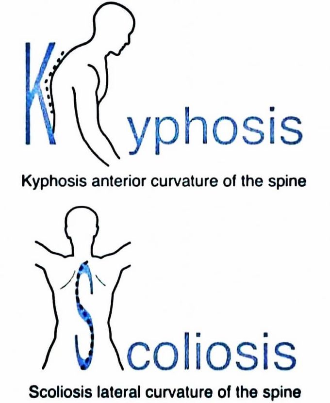 Kyphosis Vs Scoliosis