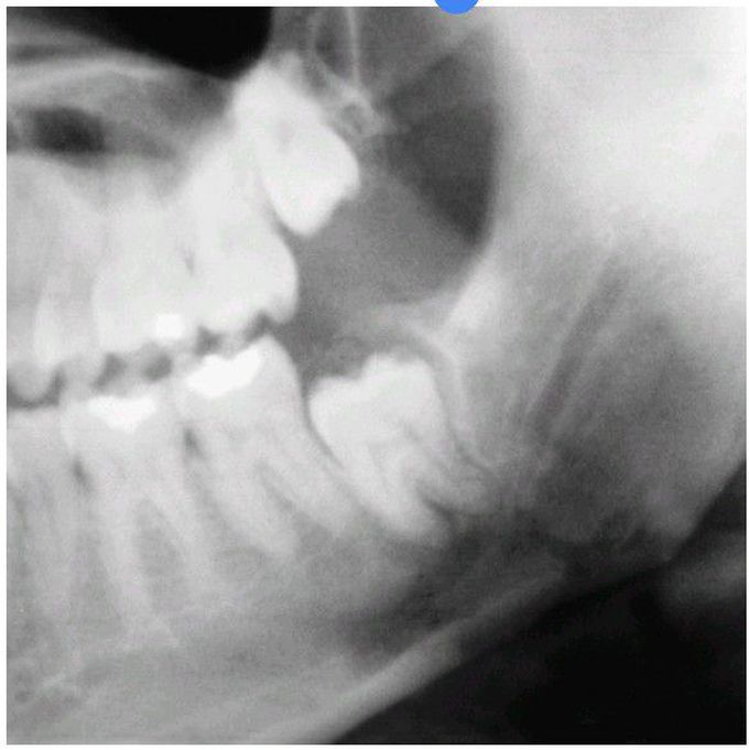 Impacted tooth and fracture