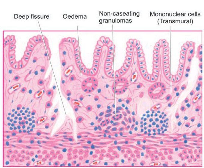 Crohn’s disease of the ileum