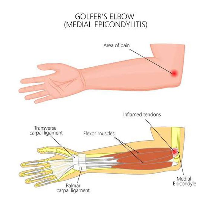 Golfer's elbow