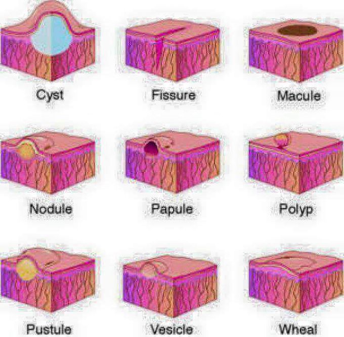 Skin Lesions