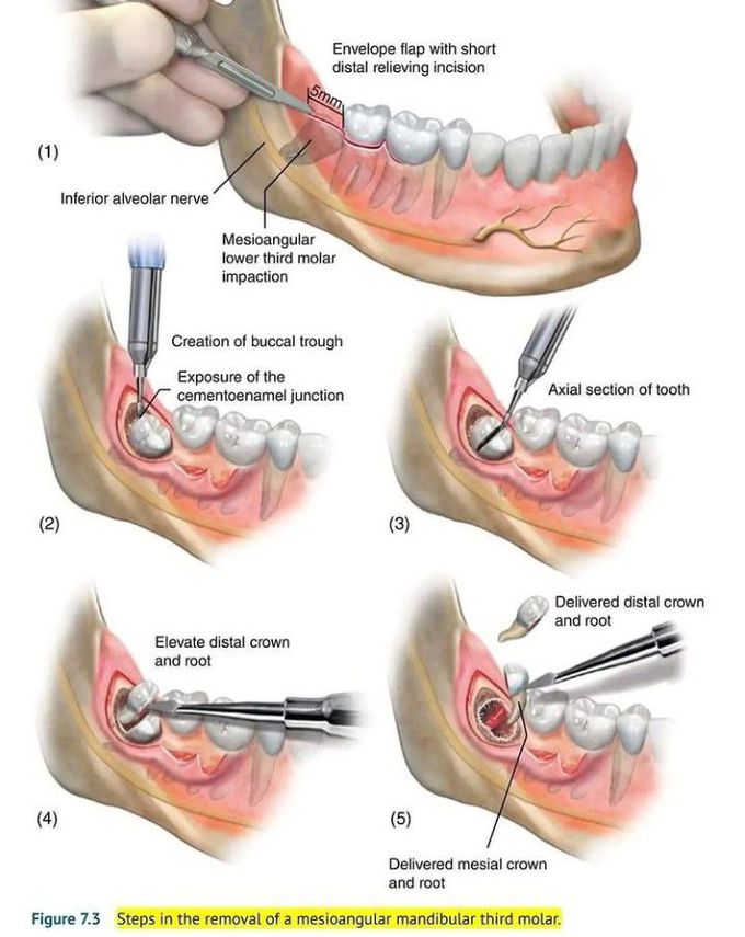 Extraction of Mesioangular Mandibular Third Molar